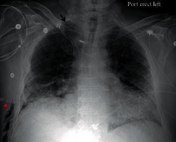 Interstitial Emphysema as a Rare Radiographic Presentation of Bronchial Dehiscence after Lung Transplant.