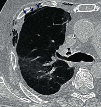 Interstitial Emphysema as a Rare Radiographic Presentation of Bronchial Dehiscence after Lung Transplant.