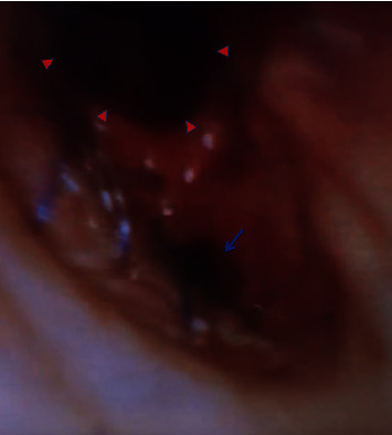 Interstitial Emphysema as a Rare Radiographic Presentation of Bronchial Dehiscence after Lung Transplant.