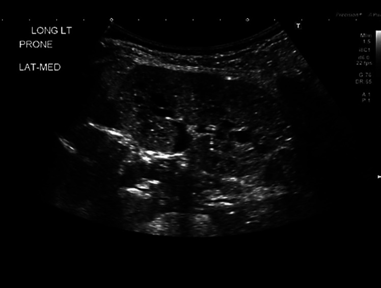 Persistent Hypoglycemia with Polycystic Kidneys: A Rare Combination - A Case Report.