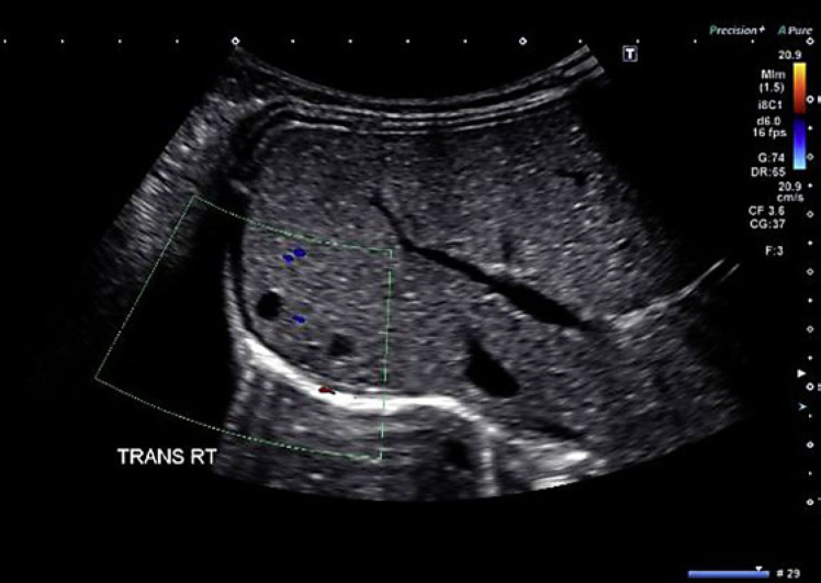 Persistent Hypoglycemia with Polycystic Kidneys: A Rare Combination - A Case Report.