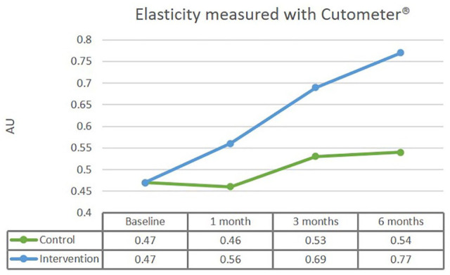 The effects of shock wave therapy applied on hypertrophic burn scars: a randomised controlled trial.