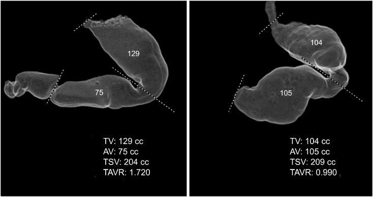 Morphologic Study of Gastric Sleeves by CT Volumetry at One Year after Laparoscopic Sleeve Gastrectomy.