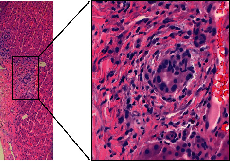 ANCA-Associated Intrahepatic Duct Injury Associated with Levamisole-Adulterated Cocaine.