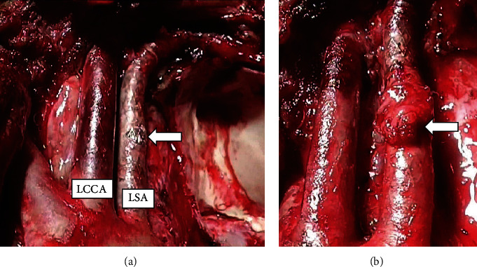 Covered Stent of the Left Common Carotid and Subclavian Arteries Assist the Invasive Tumor Resection.