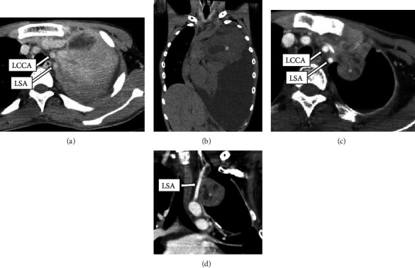 Covered Stent of the Left Common Carotid and Subclavian Arteries Assist the Invasive Tumor Resection.