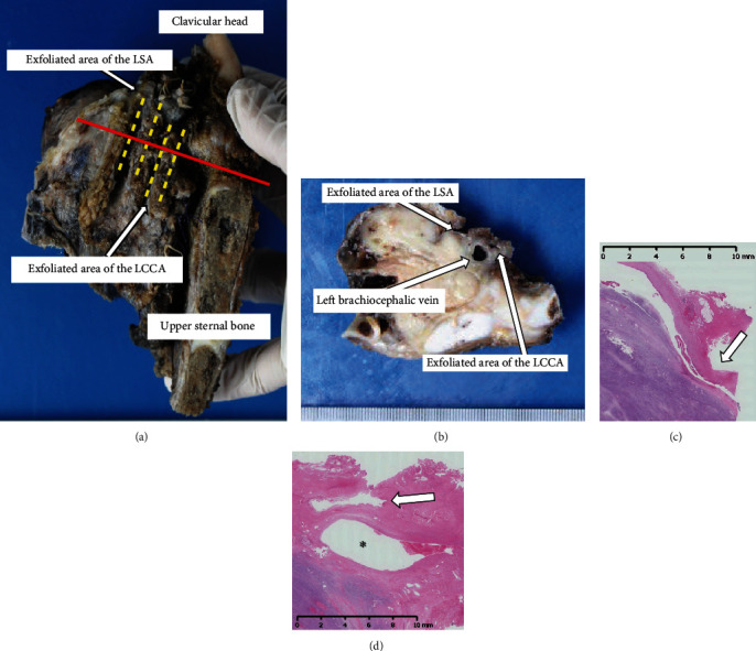 Covered Stent of the Left Common Carotid and Subclavian Arteries Assist the Invasive Tumor Resection.