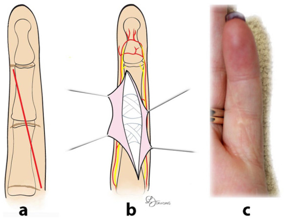 A novel approach to the proximal interphalangeal joint: The volar oblique incision - a retrospective cohort study.