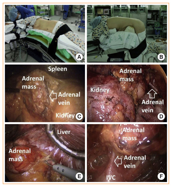 Minimally Invasive Adrenal Surgery.