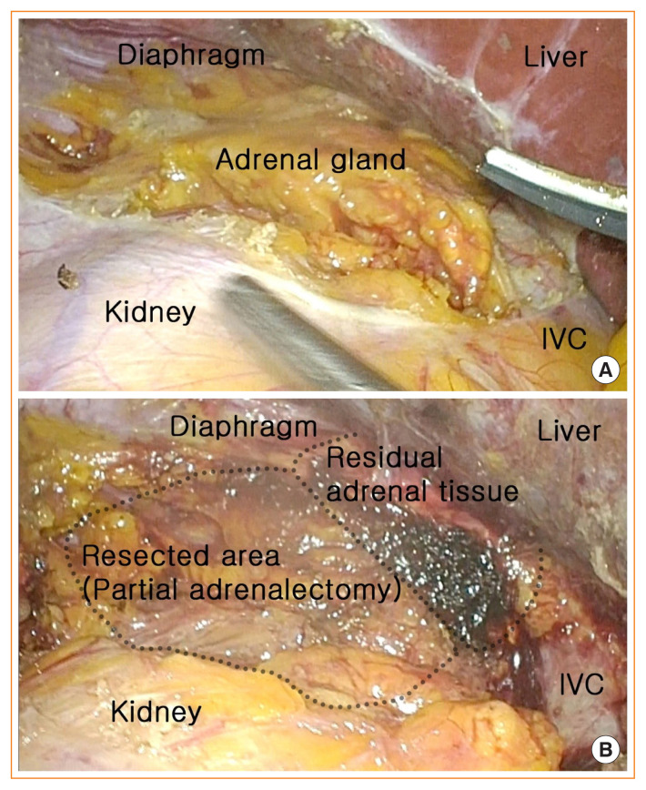 Minimally Invasive Adrenal Surgery.
