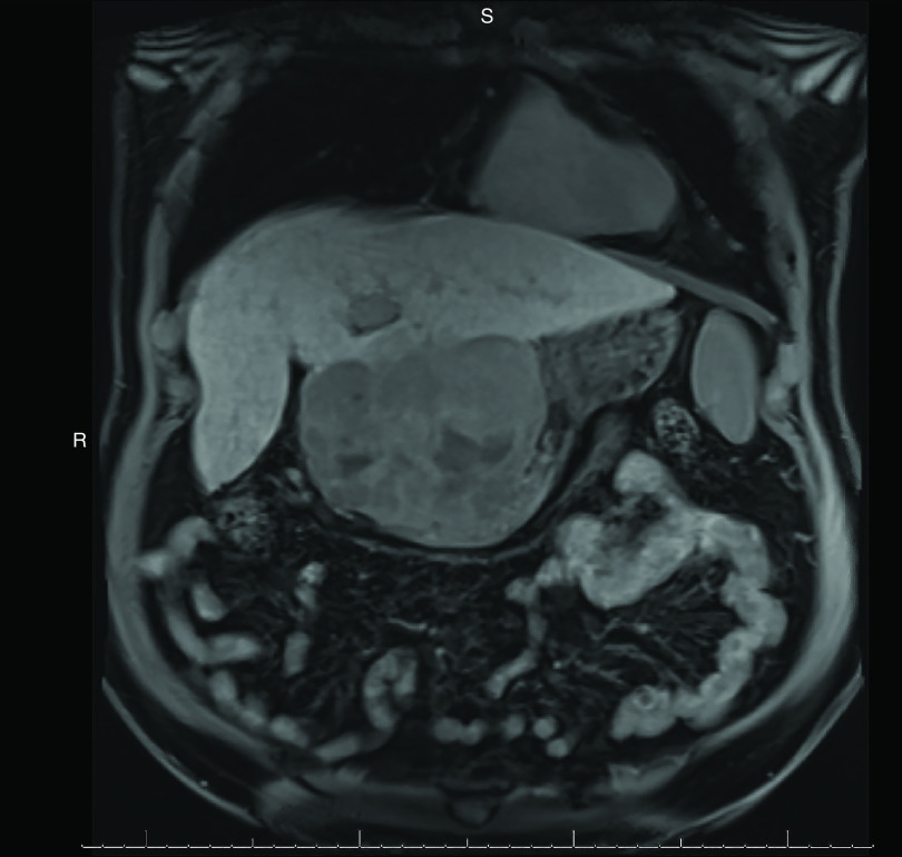 A rare histologic subtype of hepatocellular carcinoma, sarcomatoid hepatocellular carcinoma: report of a case.