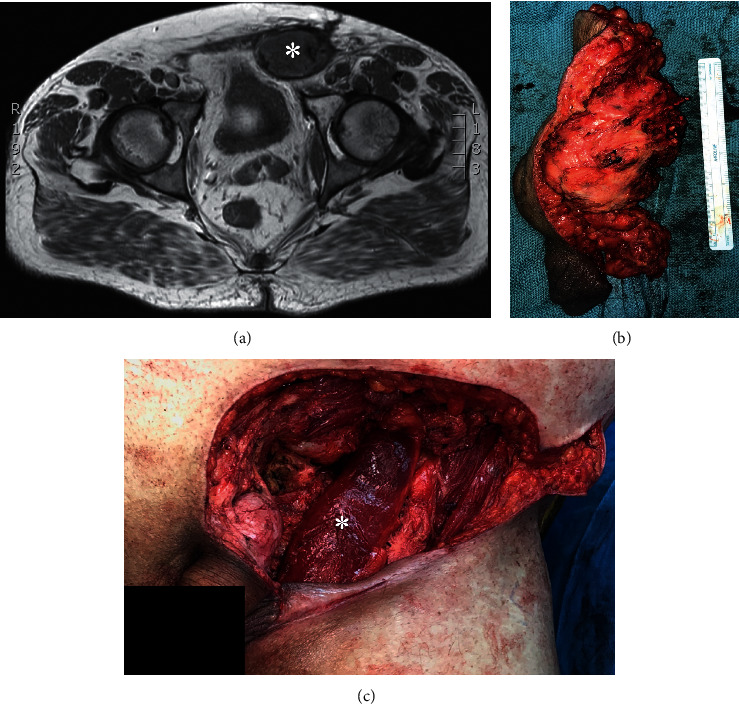 Inadvertent Inguinal Sarcoma Excision during Hernia Surgery: Outcomes, Gender Analysis, and Prevention.