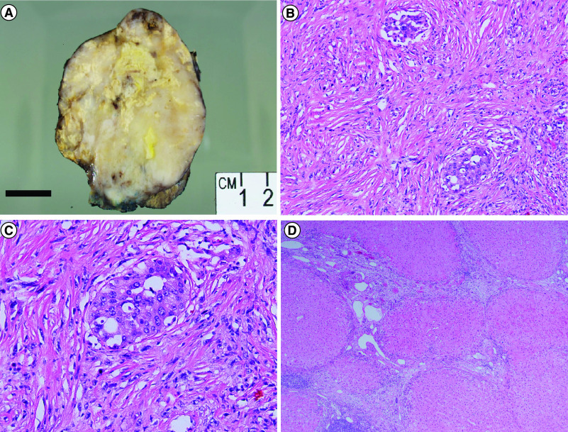 A rare histologic subtype of hepatocellular carcinoma, sarcomatoid hepatocellular carcinoma: report of a case.