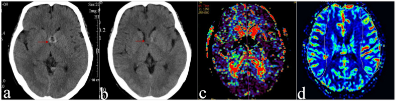 Effects of two different glycoprotein platelet IIb/IIIa inhibitors and the clinical endpoints in patients with intracranial Pipeline flow diverter implant