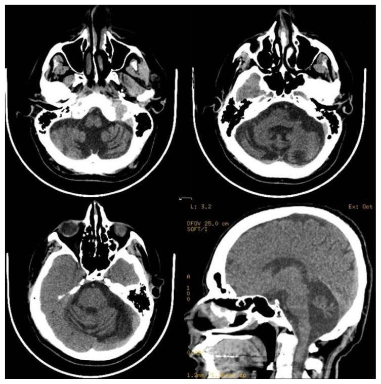 Irreversible Cerebellar Atrophy as a Complication of Short-Term Phenytoin Exposure: Clinical Improvement Following Discontinuation of the Culprit.