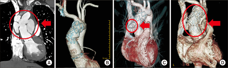 A Giant Pseudo-Aneurysm on the Anastomosis Site for a Redo Bentall Operation due to Behçet Disease Treated by Thoracic Endovascular Aortic Aneurysm Repair with a Custom-Made Stent Graft.