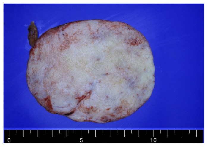 Solitary fibrous tumor of the lesser omentum mimicking stomach gastrointestinal stromal tumor.