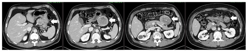 Solitary fibrous tumor of the lesser omentum mimicking stomach gastrointestinal stromal tumor.