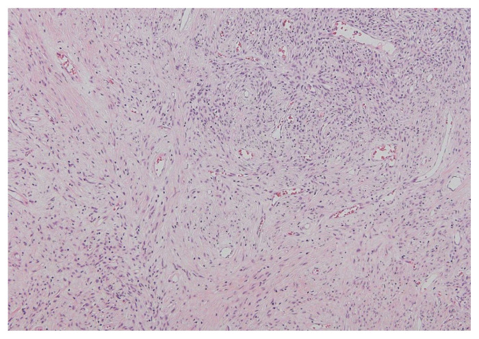 Solitary fibrous tumor of the lesser omentum mimicking stomach gastrointestinal stromal tumor.