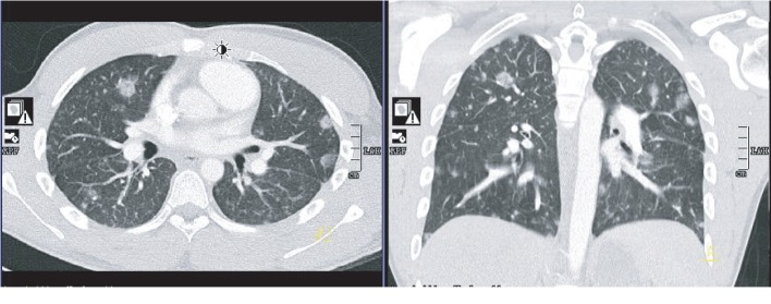 Spontaneous Chylothorax following Septic Pulmonary Embolization.