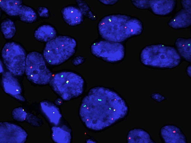 Incidence of <i>ROS1</i>-Rearranged Non-Small-Cell Lung Carcinoma in India and Efficacy of Crizotinib in Lung Adenocarcinoma Patients.