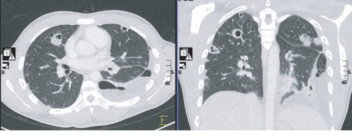 Spontaneous Chylothorax following Septic Pulmonary Embolization.