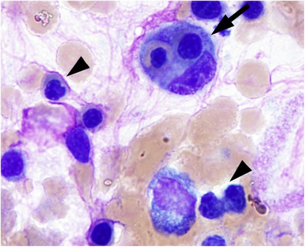 Pembrolizumab-induced Hemophagocytic Lymphohistiocytosis: an immunotherapeutic challenge.