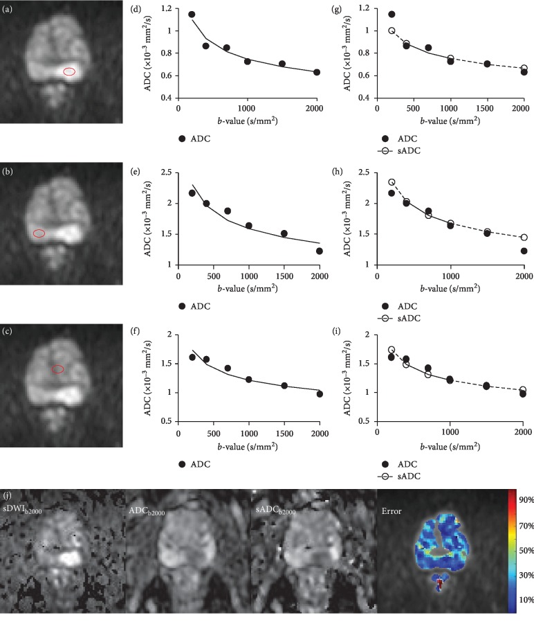 Synthetic Apparent Diffusion Coefficient for High <i>b</i>-Value Diffusion-Weighted MRI in Prostate.