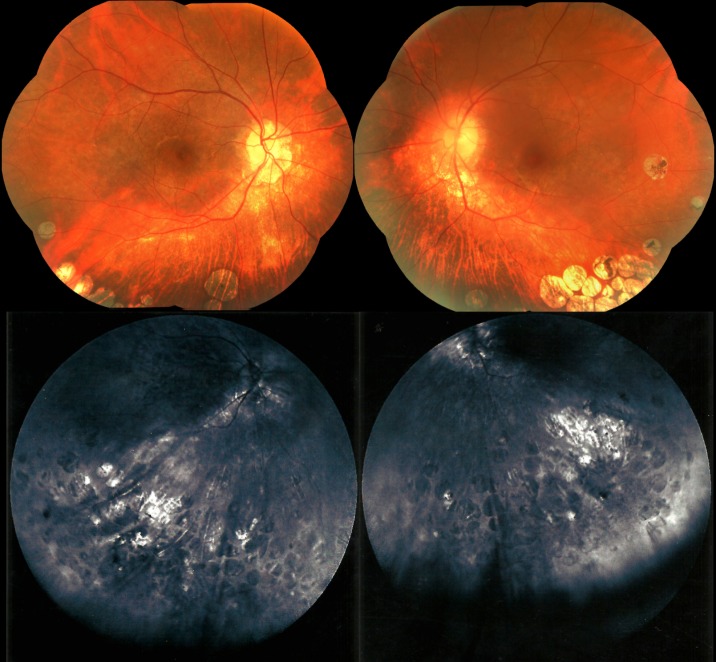 Gyrate atrophy-like phenotype with normal plasma ornithine and low plasma taurine.