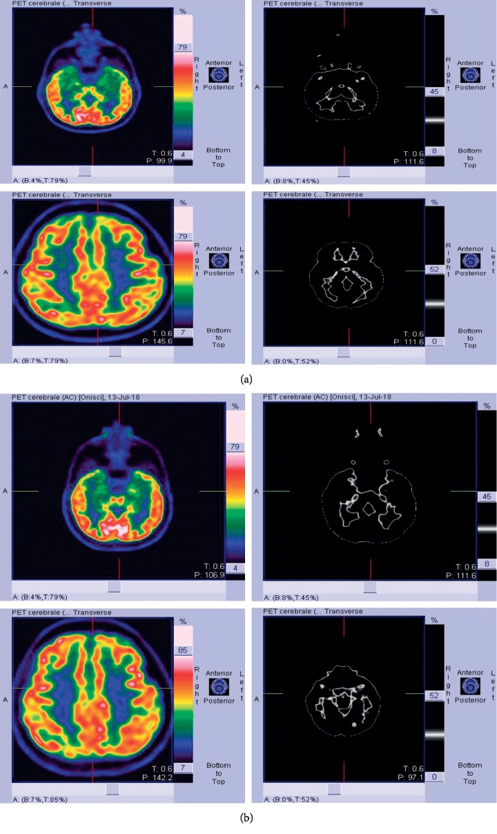 Efficacy of Tocilizumab in Limbic Encephalitis with Anti-CASPR2 Antibodies.