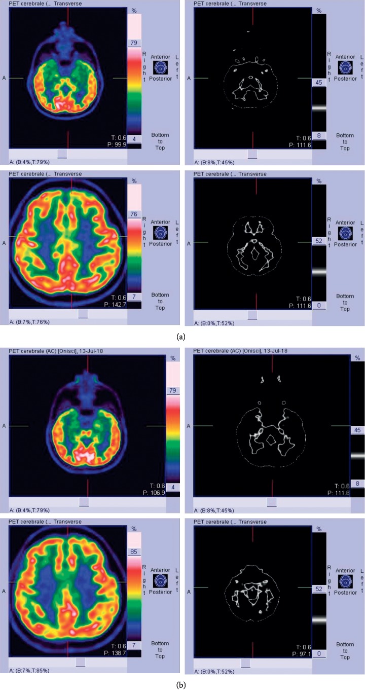 Efficacy of Tocilizumab in Limbic Encephalitis with Anti-CASPR2 Antibodies.