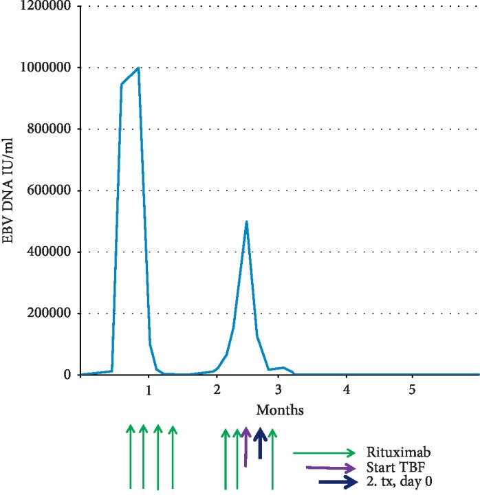 Posttransplantation Lymphoproliferative Disease Treated by Retransplantation.