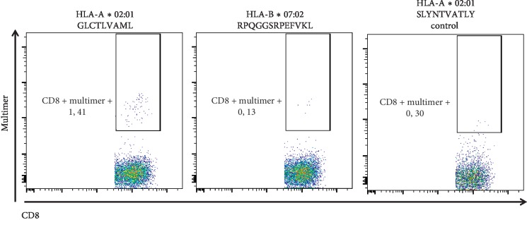 Posttransplantation Lymphoproliferative Disease Treated by Retransplantation.