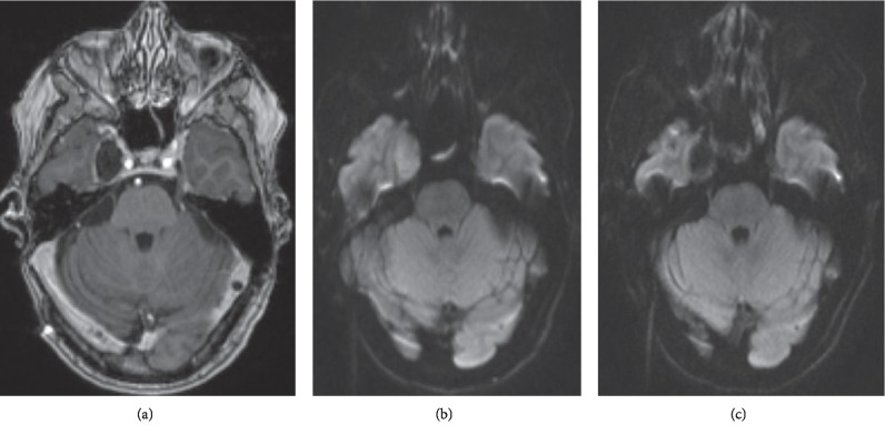 Endoscopic Endonasal Resection of Meckel's Cave Epidermoid Cysts: Case Discussion and Literature Review.