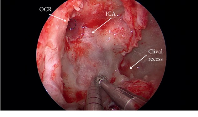 Endoscopic Endonasal Resection of Meckel's Cave Epidermoid Cysts: Case Discussion and Literature Review.