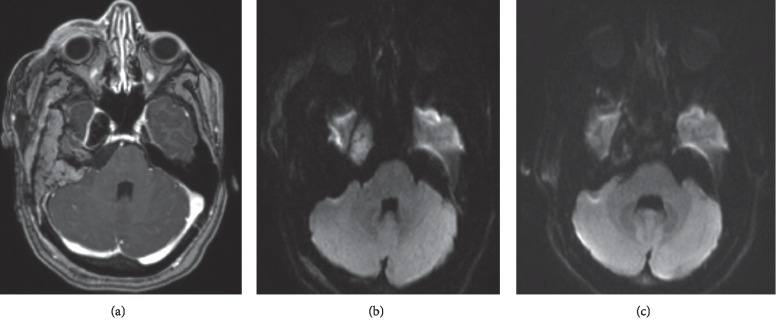 Endoscopic Endonasal Resection of Meckel's Cave Epidermoid Cysts: Case Discussion and Literature Review.