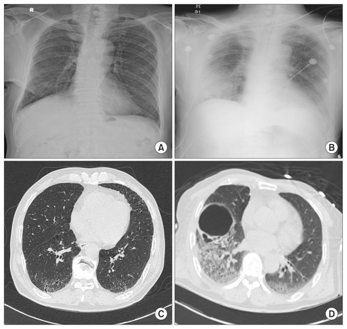 Cerebral Air Embolism and Cardiomyopathy Secondary to Large Bulla Rupture during a Pulmonary Function Test.