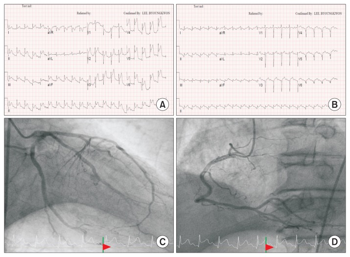 Cerebral Air Embolism and Cardiomyopathy Secondary to Large Bulla Rupture during a Pulmonary Function Test.