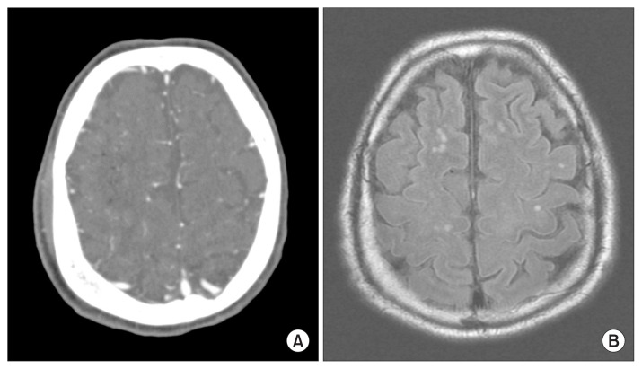 Cerebral Air Embolism and Cardiomyopathy Secondary to Large Bulla Rupture during a Pulmonary Function Test.