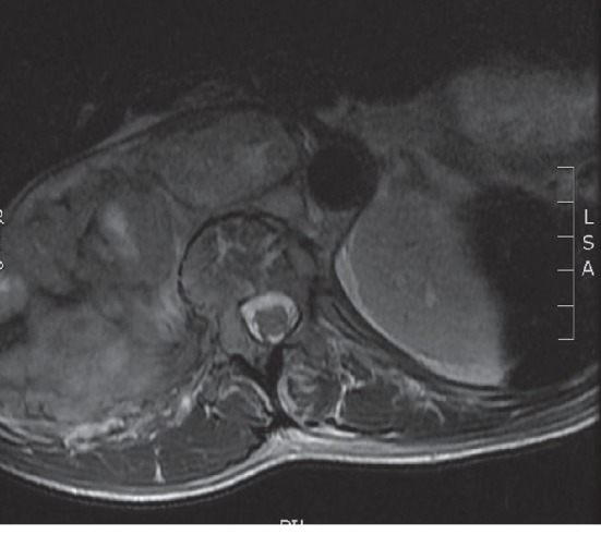 Immediate Response to Chemotherapy in an Adult Neuroblastoma Patient Presenting with Cord Compression.