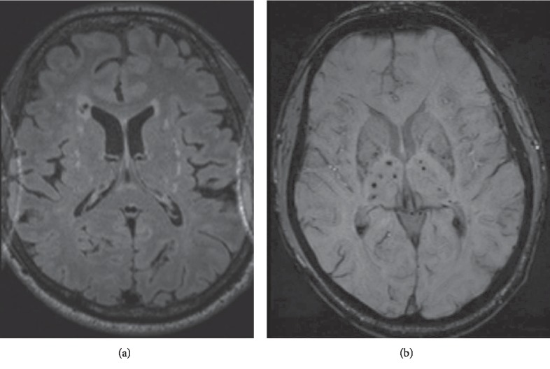 A Patient with Combined CADASIL and MTHFR Homozygosity.