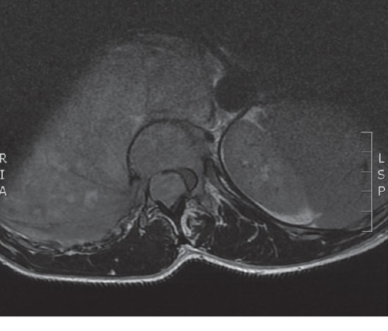 Immediate Response to Chemotherapy in an Adult Neuroblastoma Patient Presenting with Cord Compression.