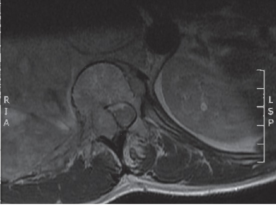 Immediate Response to Chemotherapy in an Adult Neuroblastoma Patient Presenting with Cord Compression.