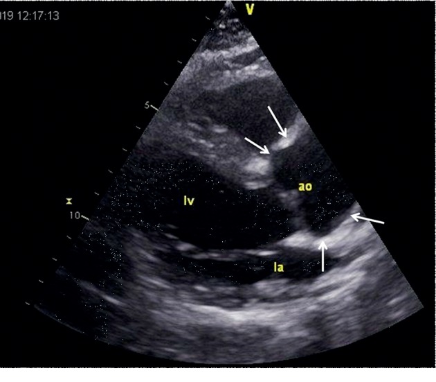 Unusual Phenotype and Disease Trajectory in Kearns-Sayre Syndrome.