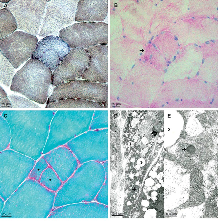 Unusual Phenotype and Disease Trajectory in Kearns-Sayre Syndrome.