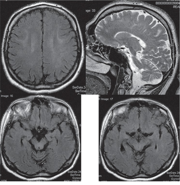 Unusual Phenotype and Disease Trajectory in Kearns-Sayre Syndrome.