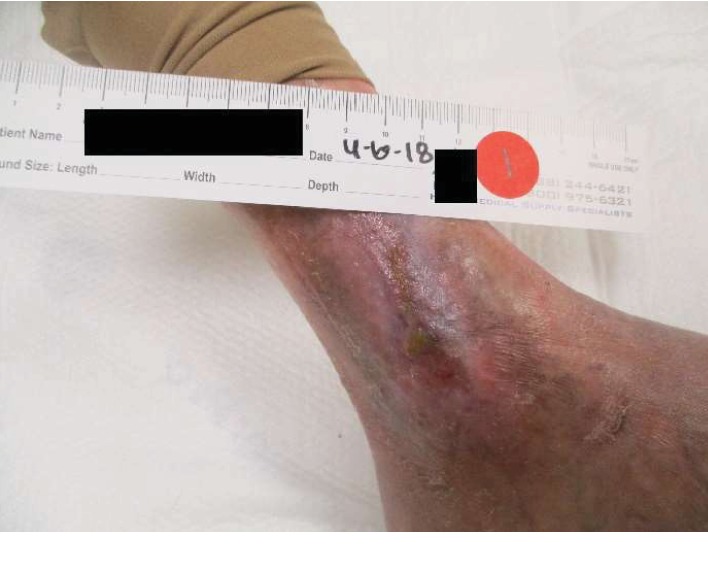 Successful Use of Hyperbaric Oxygen as Adjunctive Therapy for a Nonhealing Venous Ulcer in a Patient with Systemic Sclerosis and Pulmonary Arterial Hypertension: A Case Report and Review of the Literature.