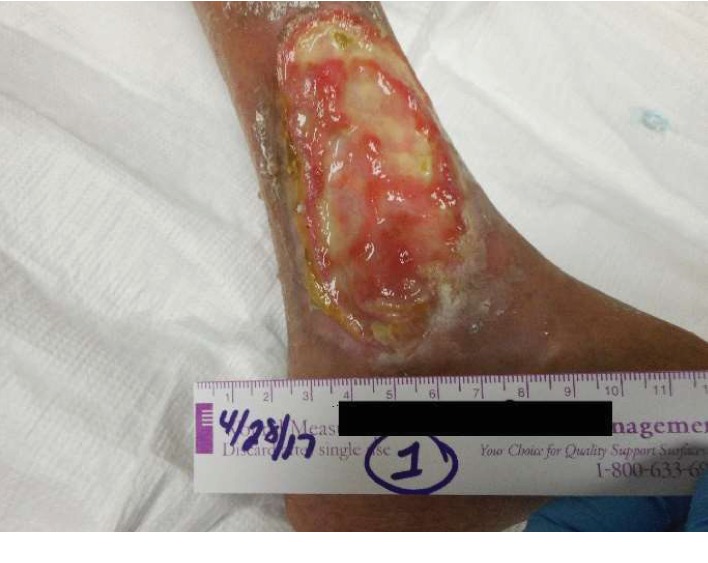 Successful Use of Hyperbaric Oxygen as Adjunctive Therapy for a Nonhealing Venous Ulcer in a Patient with Systemic Sclerosis and Pulmonary Arterial Hypertension: A Case Report and Review of the Literature.