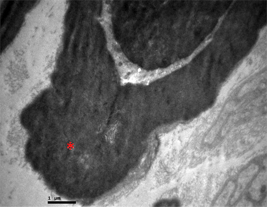 Histologic evaluation of femoral nerve demyelinating and axonal neuropathy in Wistar rats due to alendronate intake: a randomised study.