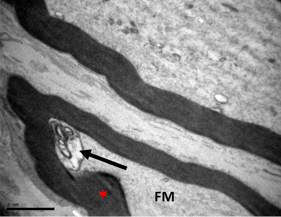 Histologic evaluation of femoral nerve demyelinating and axonal neuropathy in Wistar rats due to alendronate intake: a randomised study.